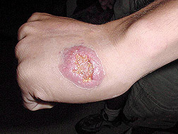 Cutaneous leishmaniasis, a skin form of the disease transmitted by sand flies: Click here for photo caption.
