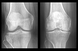 X-rays of a healthy knee and an osteoarthritic knee. Link to photo information